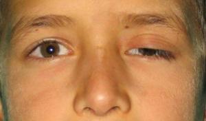 Myasthenia Gravis Nedir?