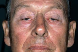 Myasthenia Gravis Nedir?