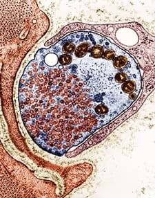 Myasthenia Gravis Nedir?