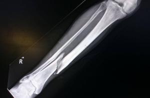 Tibia (İncik Kemiği) Kırığı