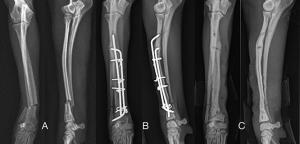 Tibia (İncik Kemiği) Kırığı