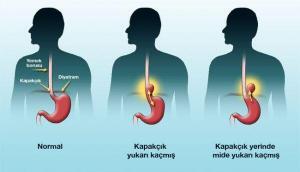 Mide Ekşimesini Teskin Edebilecek 10 Basit Öneri