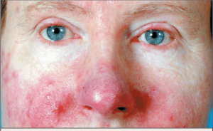 Rosacea (Roza) Hastalığı Nedir, Nasıl Bir Hastalıktır, Tedavisi Nasıl Yapılır?