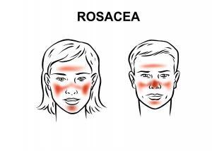 Rosacea (Roza) Hastalığı Nedir, Nasıl Bir Hastalıktır, Tedavisi Nasıl Yapılır?