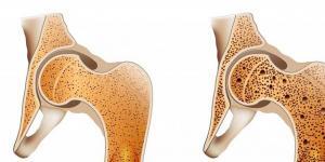 Osteokalsin (OST) Testi Nedir?