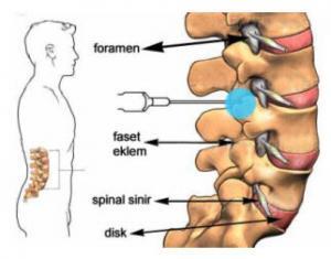 Faset Artropati Nedir?