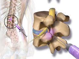 Faset Artropati Nedir?