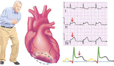 Kalp Krizi Çeşitleri