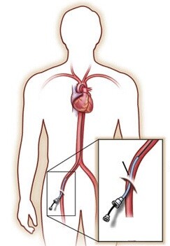 Anjiyografi Nedir?