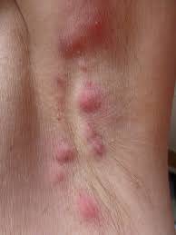 Hidradenitis Süpürativa (HS) Nedir?