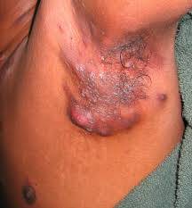 Hidradenitis Süpürativa (HS) Nedir?