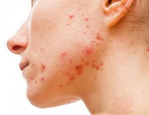 Hidradenitis Süpürativa (HS) Nedir?