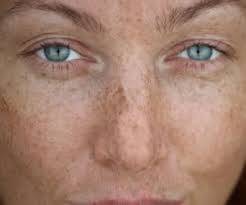Melazma Nedir?