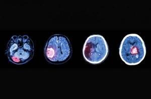 Ependimom Nedir?