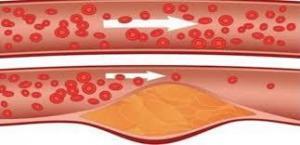 Serebrovasküler Hastalık (SVO) Nedir?