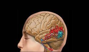 İntraserebral Kanama Nedir?