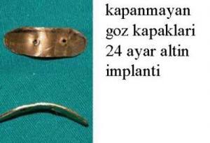 Gözler Açıkken Uyuma Olgusu: Gece Lagoftalmisi