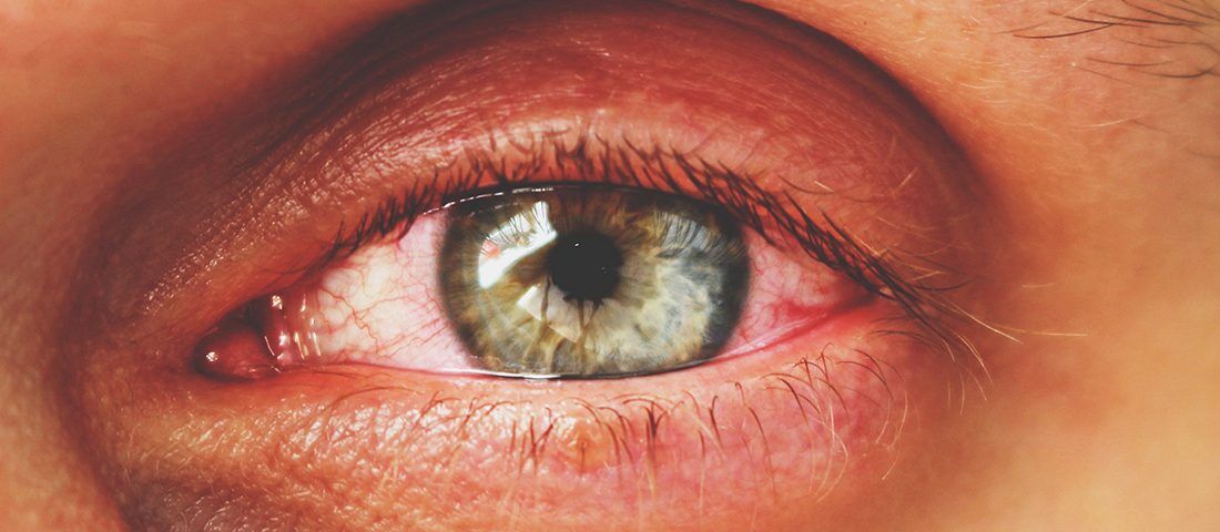 Çok Görülen 8 Göz Enfeksiyonları ve Tedavileri