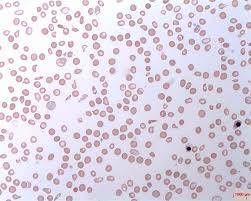 Paroksismal Cold Hemoglobinüri (PCH) Nedir?