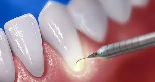 Diş Hekimliğinde Düşük Enerjili Lazer Uygulaması