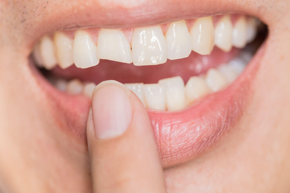 Diş Çatlağı Nedir, Nasıl Anlaşılır?