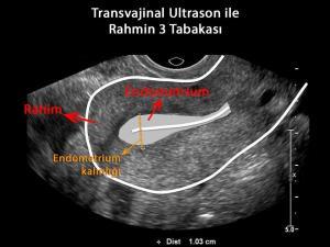 Endometrial Kalınlık Nedir? Belirtileri ve Tedavi Şekilleri Nelerdir?