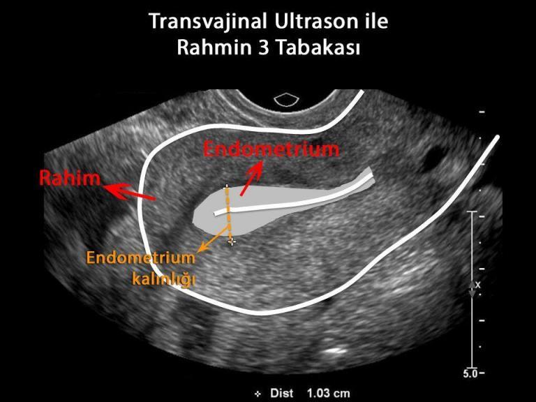 rahim duvarı incelmesi zararları