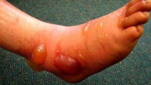 Fitofotodermatit Nedir?