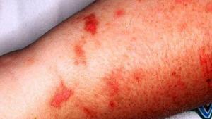 Fitofotodermatit Nedir?