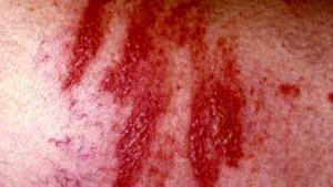 Fitofotodermatit Nedir?