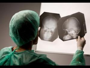 Nadir Görülen Epilepsi Çeşidi: Dravet Sendromu