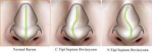 Septum Deviasyonu (Sapmış Septum) Nedenleri ve Çözümleri