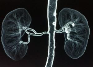 Yüksek Renin Nedenleri, Belirtileri ve Genetiği