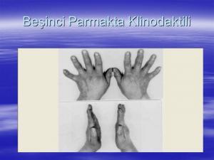 Klinodaktili Nedir?