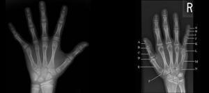 Klinodaktili Nedir?