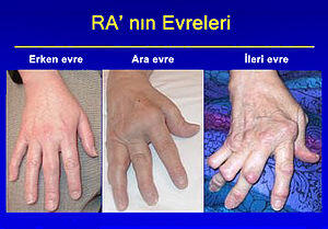 Tedavi Edilmeyen Romatoid Artrit'in Riskleri