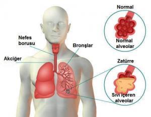 Yürüyen (Atipik) Pnömoni Nedir? Normal Pnömoniden Farklı mıdır?