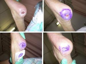Kristal Viyolen'in (Gentian Violet)  Sağlık Açısından Faydaları