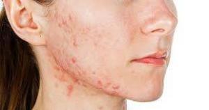 Resveratrolün Yaşlanma, Cilt ve Antiviral Etkileri