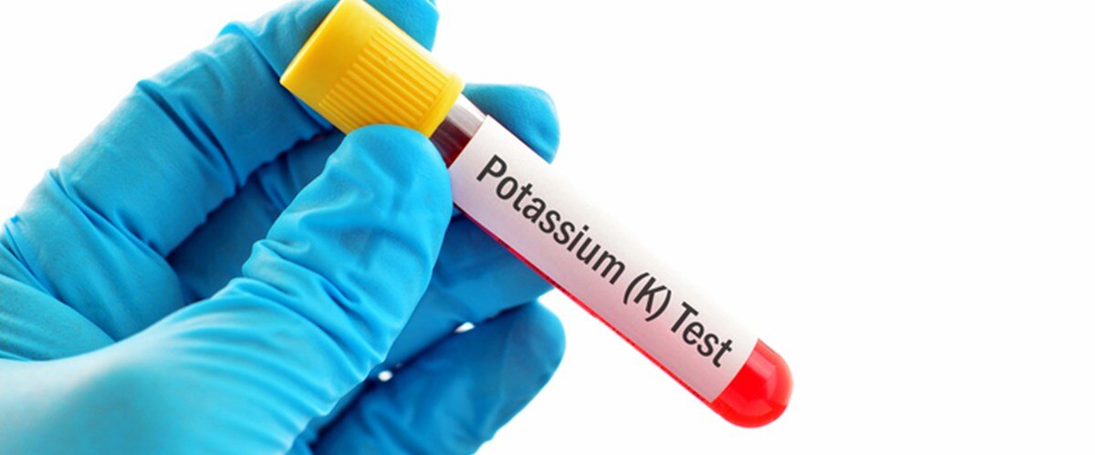 Potasyum Kan Testi Nedir, Düşük ve Yüksek Seviyeleri Ne İfade Eder?