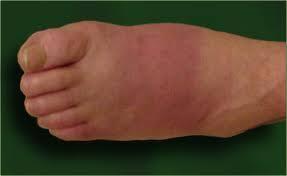 Bacillus Subtilis (B. Subtilis) Nedir?