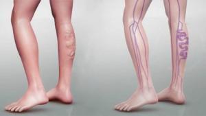 Derin Ven Trombozunun (DVT) Önlenmesine Yardımcı Olacak Diyet İpuçları