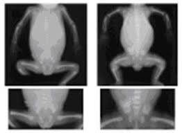 Akondroplazinin Altında Yatan Genetik: FGFR3 Geni