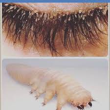 Demodex Nedir, Neye Sebep Olur, Nasıl Tedavi Edilir?