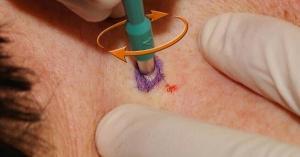 Demodex Nedir, Neye Sebep Olur, Nasıl Tedavi Edilir?