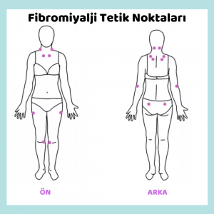 Fibromiyalji: Belirtileri, Tetik Noktaları, Risk Faktörleri ve Tedavisi