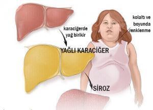 Yağlı Karaciğer Nasıl Bir Hastalıktır? Sebepleri, Belirtileri, Yapılması veya Yapılmaması Gerekenler