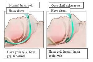 Uyurken Ağızdan Neden Salya Akar, Salya Nasıl Durdurulabilir?
