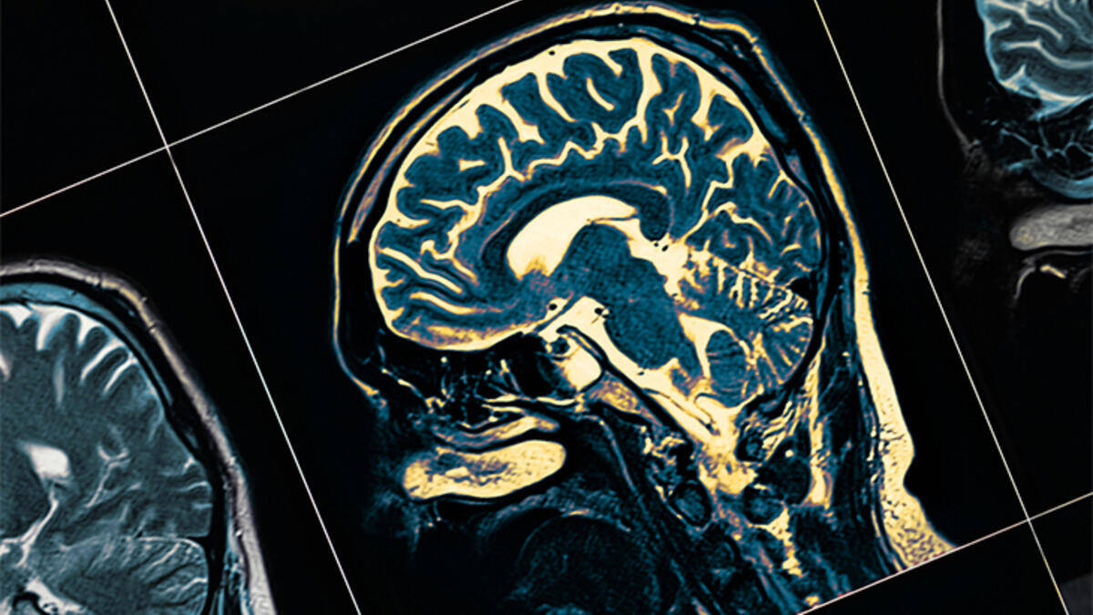 Nörodejeneratif Hastalıklar Nelerdir, Beyni Nasıl Etkiler?