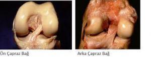 Ön Çapraz Bağ (ACL) Yırtılması Nedir, Tanı Nasıl Koyulur?